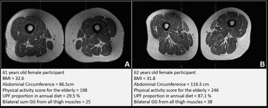 Representative axial T1 weighted spin echo thigh MRI scans in (A) a 61 year old female participant and (B) a 62 year old female participant