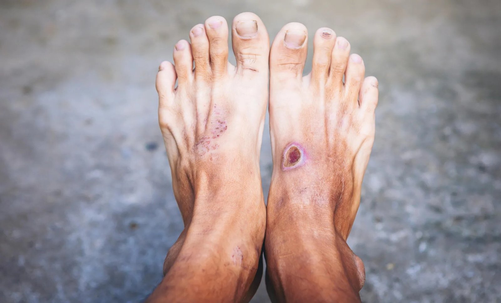 Scientists Uncover the Problem That Keeps Diabetic Foot Wounds Open for Months