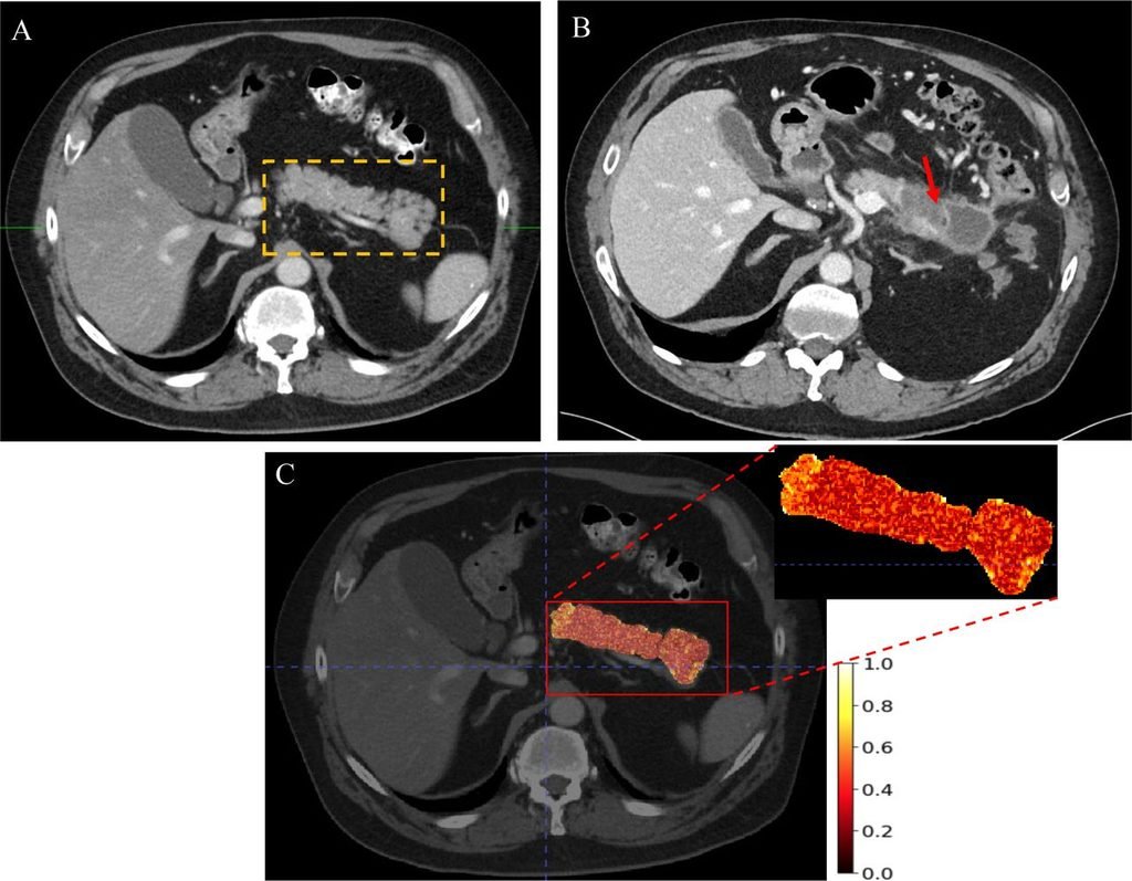 Identification of occult radiomic signatures by REDMOD in a pre diagnostic CT scan 2.4 years prior to clinical diagnosis