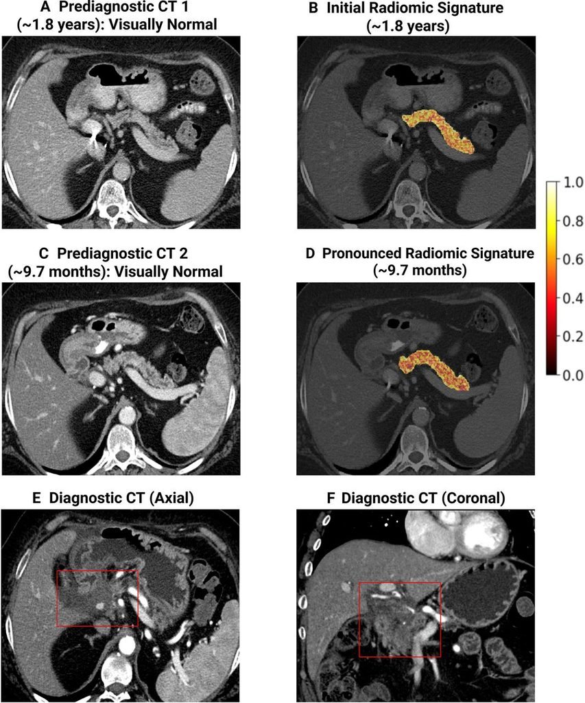Longitudinal tracking of pre clinical pancreatic ductal adenocarcinoma (PDA)