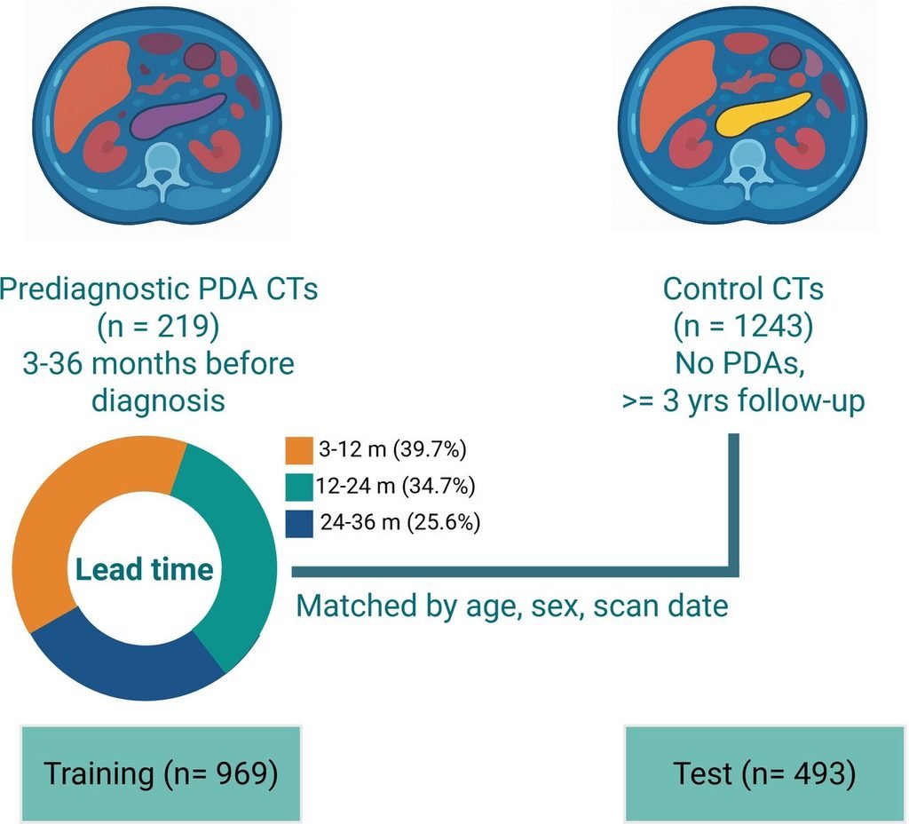 Pre diagnostic CT scans from patients who later developed pancreatic ductal adenocarcinoma