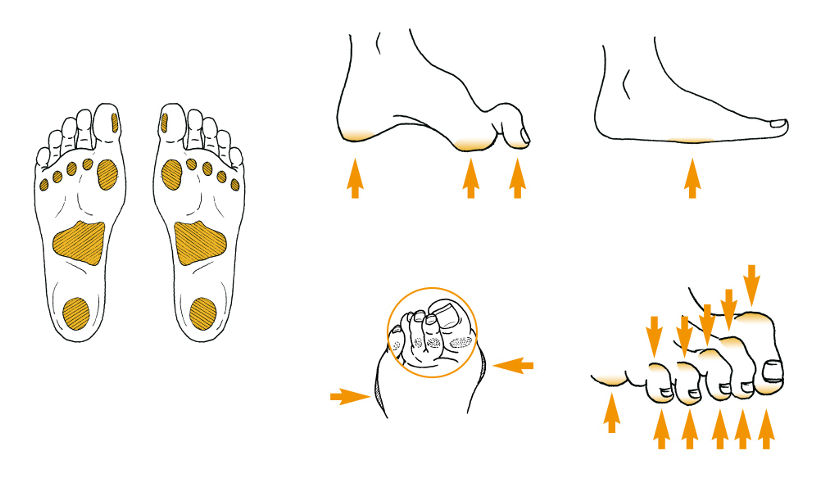 Areas of the foot at highest risk for ulceration