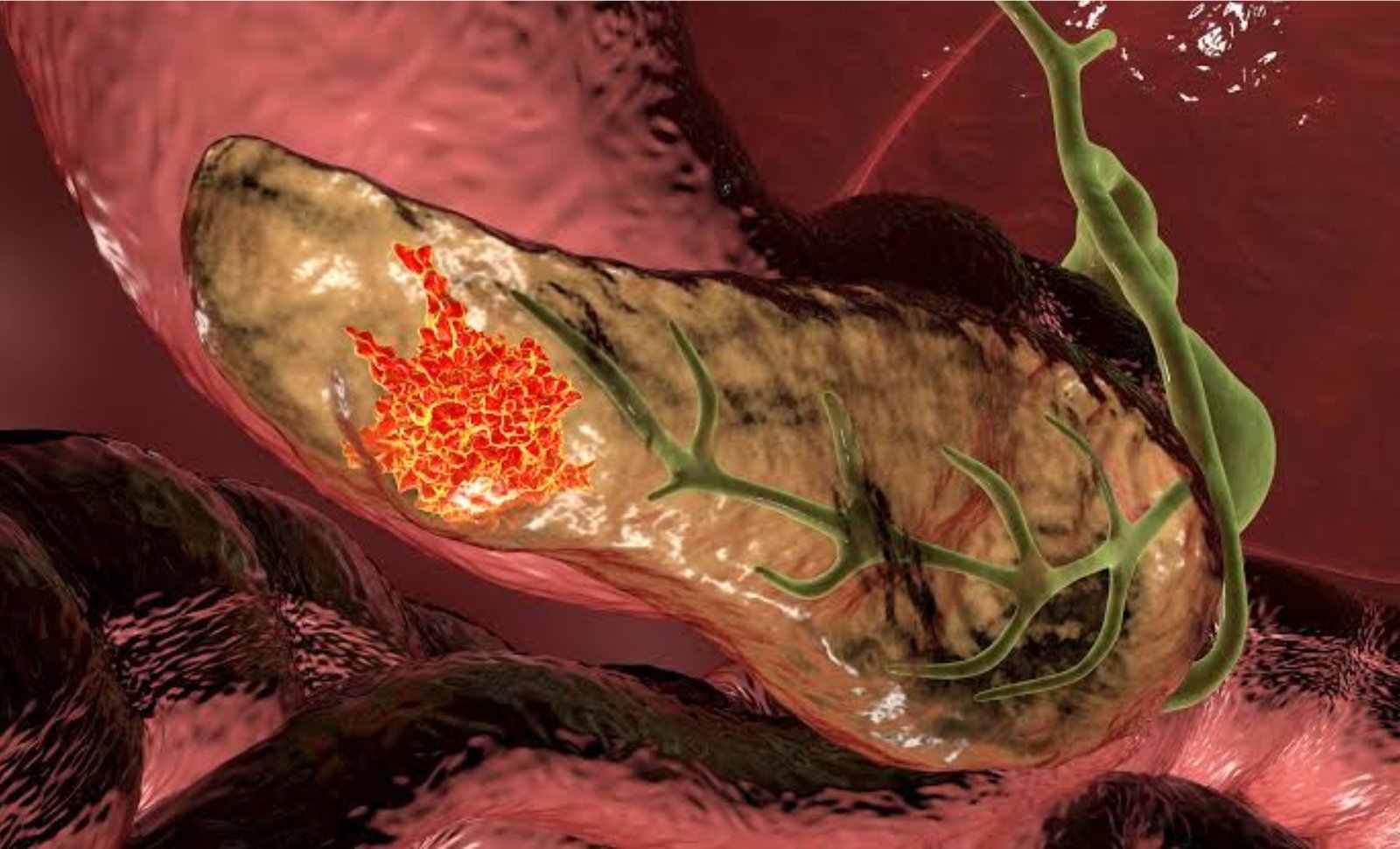 Pancreatic cancer